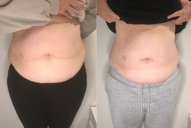 Velalaser EMS+RF+Lipolézer – részlet és kezelési eredmény