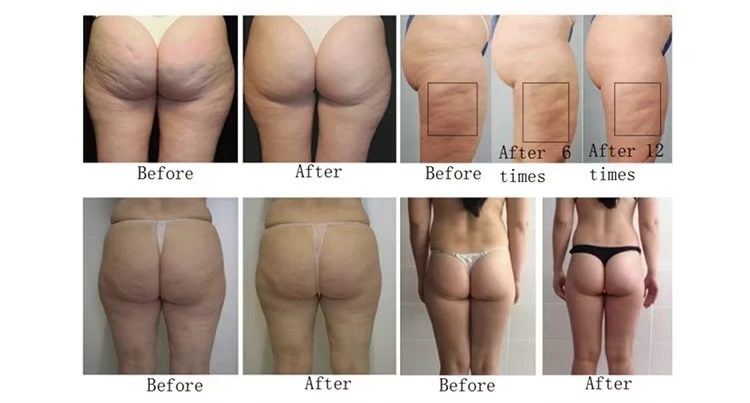 EMSLIM EMS+Roller – részlet és kezelési eredmény