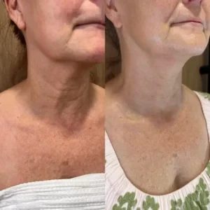PlasmaOne – részlet és kezelési eredmény