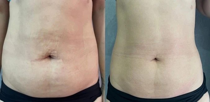 Velalaser EMS+RF+Lipolézer – részlet és kezelési eredmény